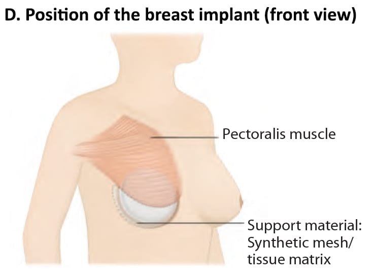 Mastectomy With Breast Reconstruction